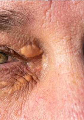 Xanthelasma (cholesterol deposit) treatment Windsor